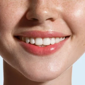 Composite Smile Design: Resin Veneers